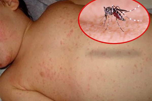 Dấu hiệu trẻ sốt xuất huyết, tay chân miệng cần nhập viện-3