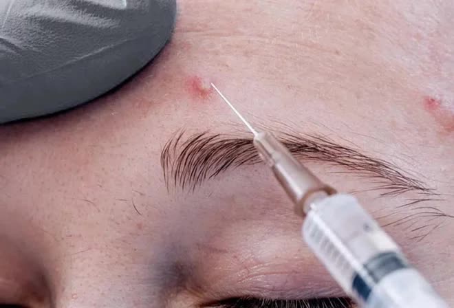 Mùa hè khiến da nổi mụn trứng cá gây mất thẩm mỹ, muốn khắc phục tận gốc, chị em cần lưu ý 5 điều-4