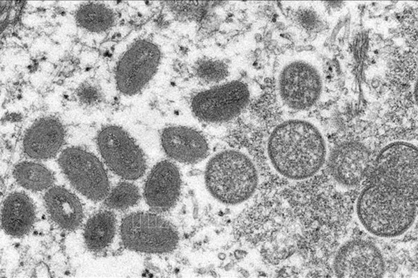 Người đàn ông bị hoại tử mũi vì mắc đậu mùa khỉ-2