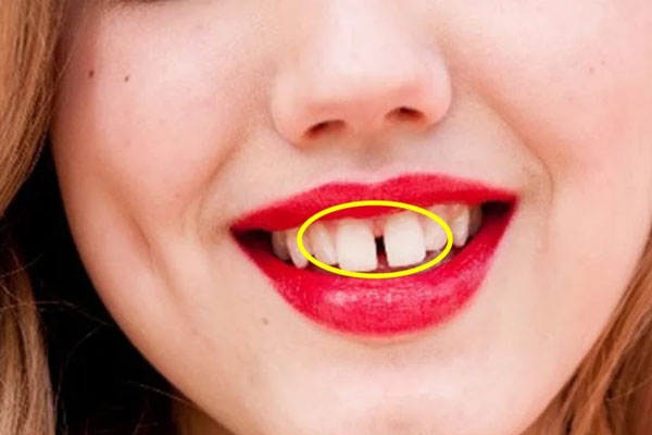 Nhìn tướng răng biết tương lai thành công hay nghèo khổ: Người răng cửa thưa đừng mong tích lũy-2