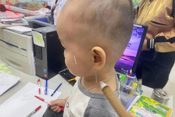 Bé 1 tuổi liệt mặt do nằm quạt-1