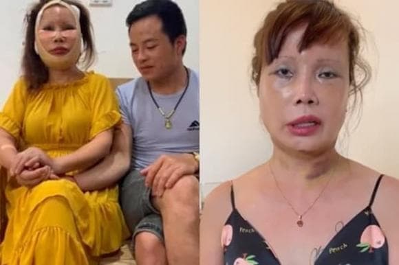 Cô dâu 62 tuổi hiện tại trông thế nào sau biến chứng thẩm mỹ khiến mặt biến dạng?-2