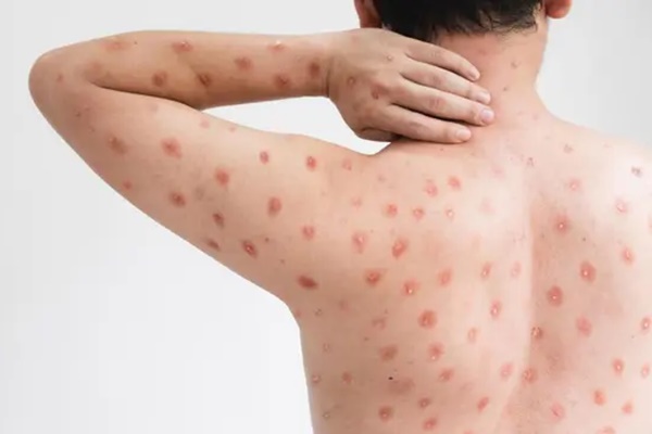 Xuất hiện dịch cúm cà chua rất dễ lây lan ở trẻ em tại Ấn Độ-2