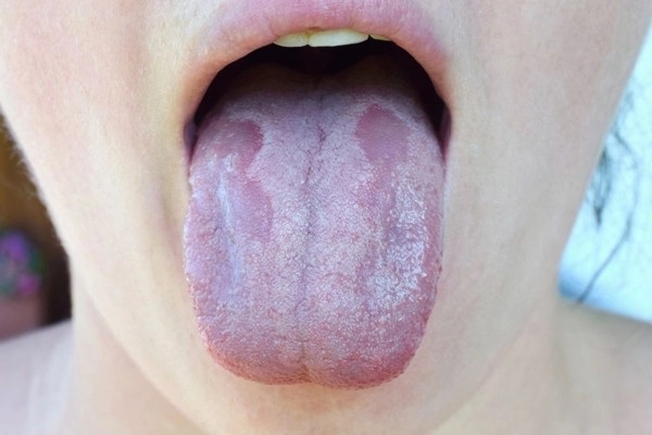 Lưỡi bỗng xuất hiện đốm trắng có thể là dấu hiệu của 3 thứ bệnh, đặc biệt là loại ung thư nguy hiểm này-1