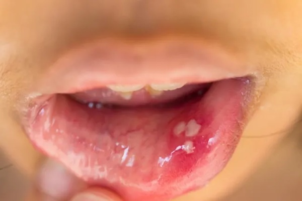 Lưỡi bỗng xuất hiện đốm trắng có thể là dấu hiệu của 3 thứ bệnh, đặc biệt là loại ung thư nguy hiểm này-4