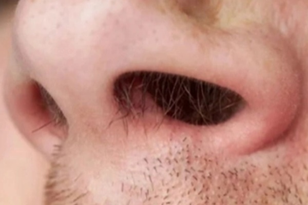 Infographic: Phân biệt đậu mùa khỉ với đậu mùa, thủy đậu và tay chân miệng qua nốt ban trên da-3