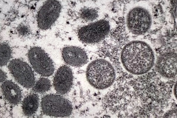 Người đàn ông bị chẩn đoán mắc HIV, COVID-19, đậu mùa khỉ cùng lúc-2