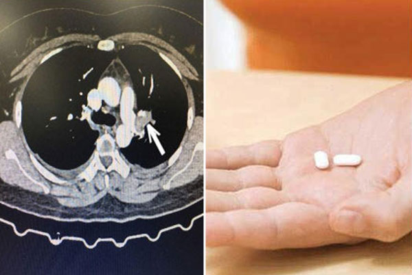 Đau đầu liên tục, tắc tĩnh mạch não do lạm dụng thuốc tránh thai-1