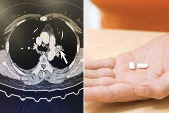 Uống 12-15 viên thuốc tránh thai khẩn cấp mỗi tháng, người phụ nữ phải nhập viện cấp cứu