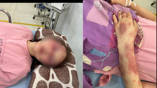 Vụ bị đánh do song ca ở quán karaoke: Nạn nhân gãy xương hàm-1