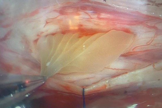 Hay ăn đồ sống, gỏi, người đàn ông bị liệt gần như hoàn toàn 2 chân vì... nang sán nội tủy