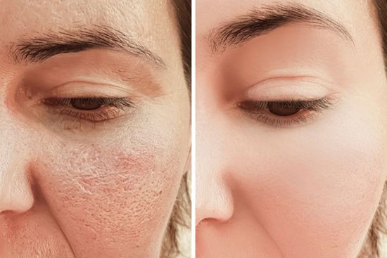 7 mẹo thu nhỏ lỗ chân lông tự nhiên được chuyên gia khuyên dùng