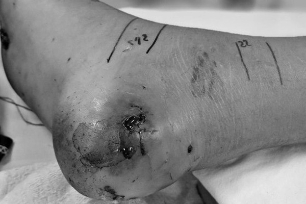 Hoại tử phải cắt bỏ ngón tay do đắp thuốc nam vào vết rắn cắn-2