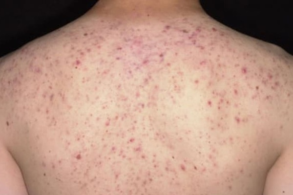 Lăn kim trị mụn lưng, người phụ nữ trẻ suýt mất mạng-1