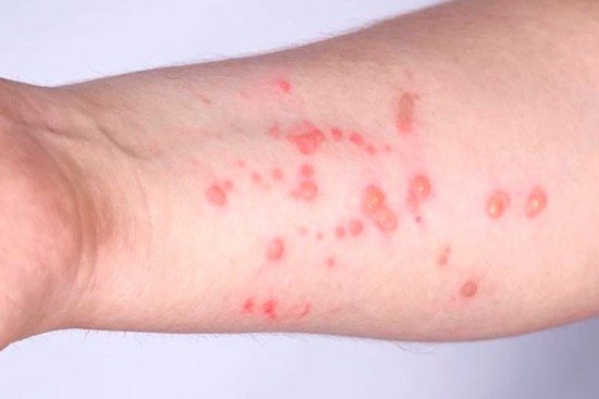Các giai đoạn phát ban của đậu mùa khỉ