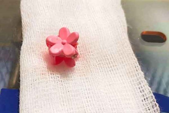 Chiếc kẹp tóc khiến bé gái bị viêm nhiễm vùng kín