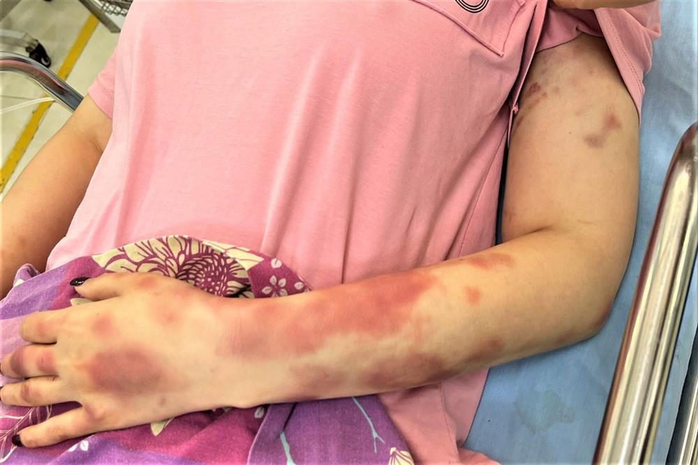 Vụ đánh người tình vì song ca với người khác: Công an đưa nạn nhân đi giám định thương tật-2