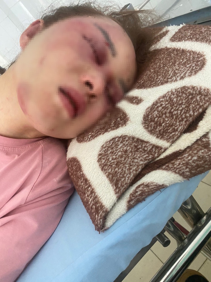 Vụ đánh người tình vì song ca với người khác: Công an đưa nạn nhân đi giám định thương tật-3