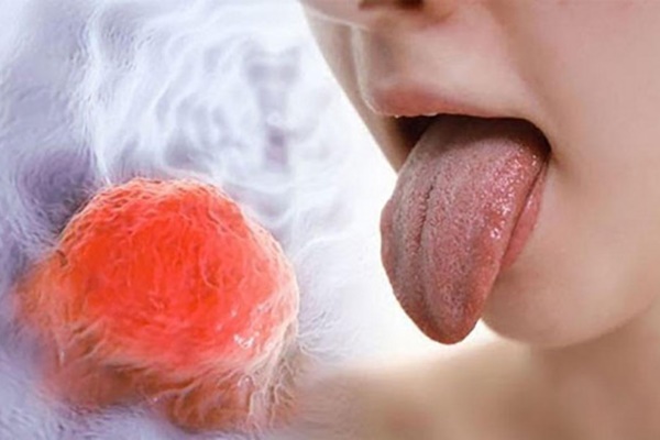 Tê bì, gai gợn ở lưỡi, dấu hiệu nhận biết sớm nhất của ung thư lưỡi-2
