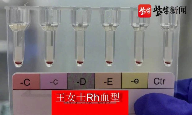 Phát hiện 2 người có nhóm máu vàng hiếm nhất trên thế giới tại Trung Quốc-1