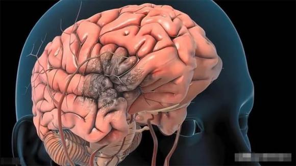 Trước khi xuất hiện xuất huyết não, cơ thể thường có 5 tín hiệu” lớn này, đừng chậm trễ sau khi phát hiện-1
