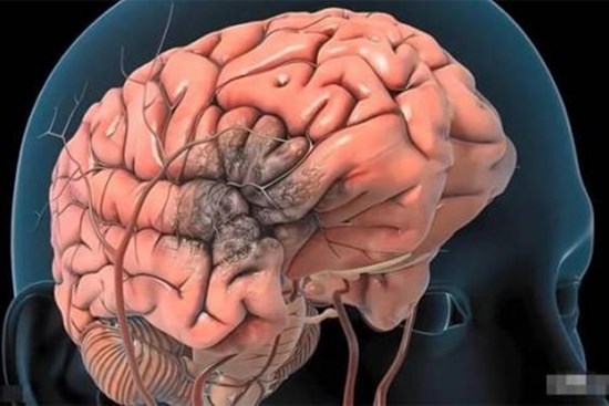 Trước khi xuất hiện xuất huyết não, cơ thể thường có 5 “tín hiệu” lớn này, đừng chậm trễ sau khi phát hiện