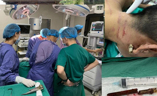 Phú Thọ: Cứu sống nam thanh niên bị thanh tre đâm xuyên cổ-1