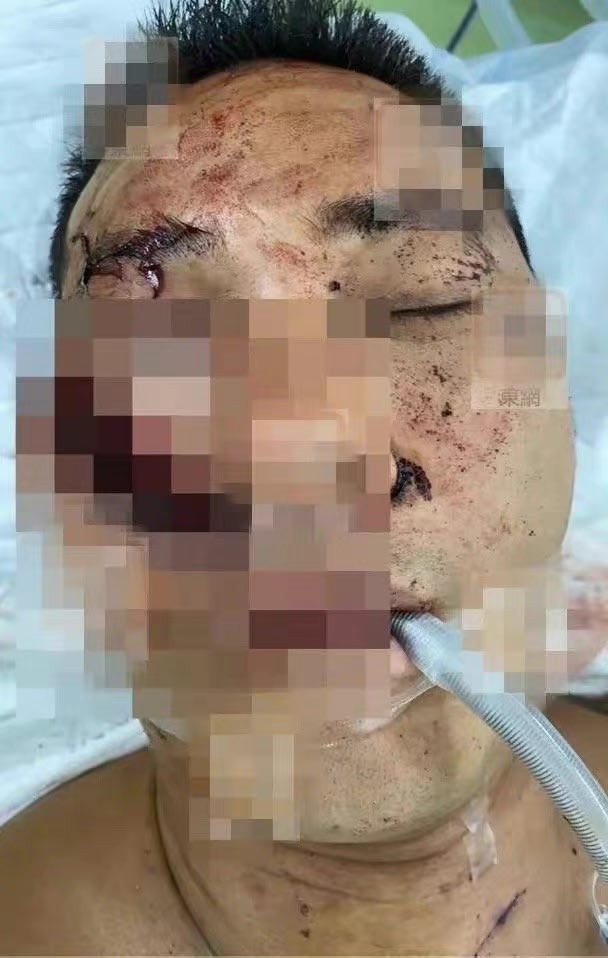 Diễn viên Hoàng Tuấn Phong bị chém 3 nhát vào mặt, bất tỉnh tại chỗ-1
