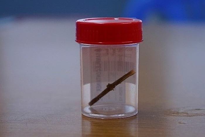 Người đàn ông bị thủng bao tử vì nuốt xác trà-1