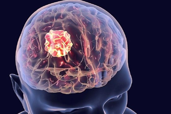Người mẫu Châu Kim Sang qua đời do ung thư não: Dấu hiệu nhận biết bệnh là gì?