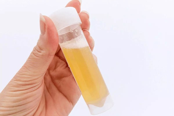 Đi tiểu gặp 3 dấu hiệu này cần kiểm tra lượng đường huyết có tăng không-2