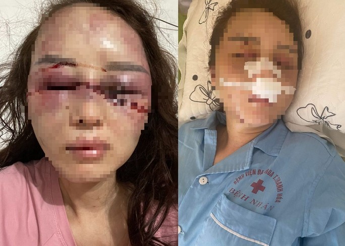 Bắt cán bộ Cục Quản lý thị trường Thanh Hóa đánh bạn gái dã man vì hát song ca với người khác-2