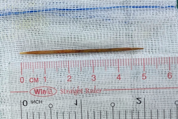 Quảng Bình: Nam thanh niên bị cây dao dài cắm xuyên giữa bụng-1