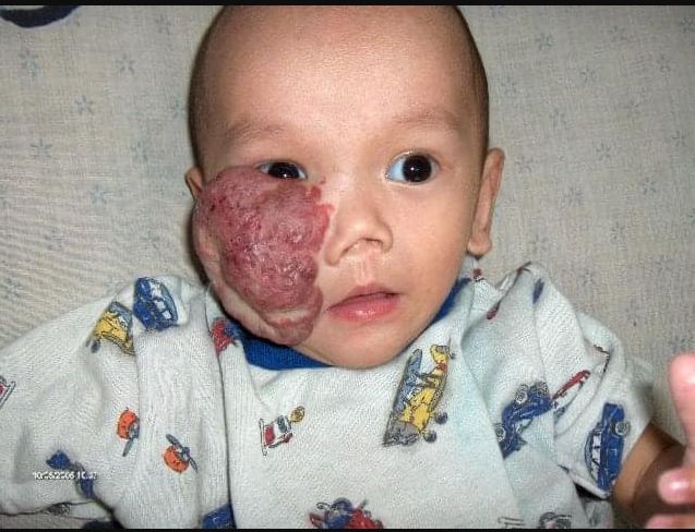 Cuộc hồi hương sau 16 năm của cậu bé gốc Việt có khối u che nửa mặt được mẹ Mỹ nhận nuôi-2