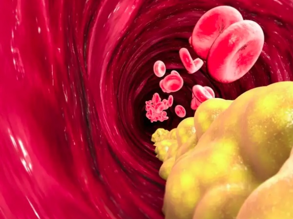 Đau ở 3 vùng này có thể là dấu hiệu của cholesterol cao-3