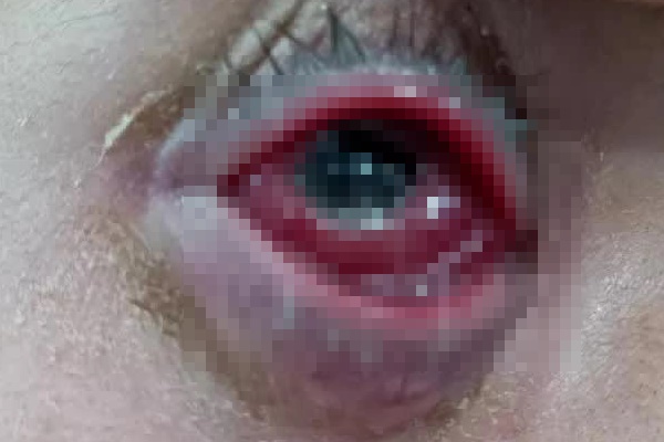 Ngỡ ngàng nam thanh niên nhập viện vì mắc bệnh lậu... ở mắt-1