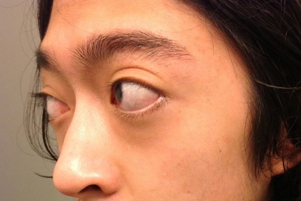 5 bất thường ở mắt là dấu hiệu bệnh tật của gan, túi mật, tụy, dạ dày và não bộ-2