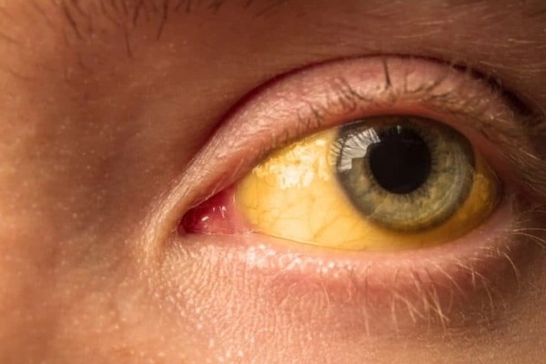5 bất thường ở mắt là dấu hiệu bệnh tật của gan, túi mật, tụy, dạ dày và não bộ-5