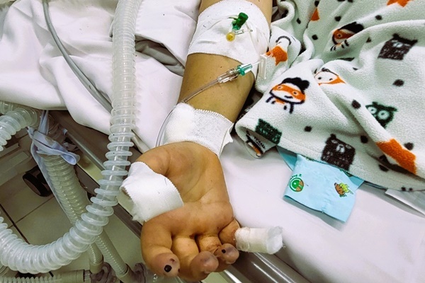 Nhiều trẻ sốt xuất huyết gặp biến chứng nặng, động đâu cũng chảy máu-1