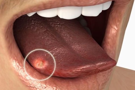 Tê bì, gai gợn ở lưỡi, dấu hiệu nhận biết sớm nhất của ung thư lưỡi