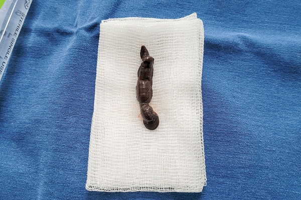 Phát hiện con đỉa dài 5 cm sống trong mũi thiếu niên 15 tuổi-2