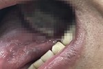 Người phụ nữ 39 tuổi phải cắt bỏ lưỡi sau khi bị ung thư giai đoạn 3, bác sĩ cảnh báo dấu hiệu phát hiện bệnh mà nhiều người bỏ qua-3