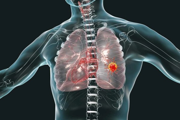 9 tín hiệu cảnh báo bệnh ung thư có thể đang tấn công bạn-1