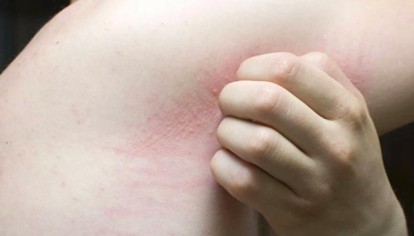 Hai bộ phận trên cơ thể bị ngứa rất có thể là dấu hiệu của bệnh xơ gan, thủ phạm là 3 thứ này trong bếp-3