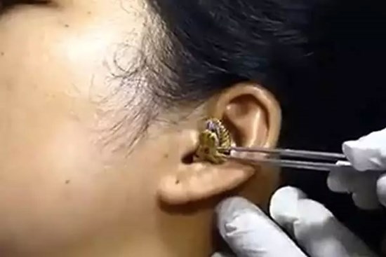 Xôn xao clip rắn chui vào tai người không chịu ra