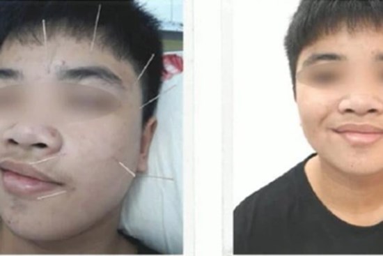 Bệnh 'khẩu nhãn oa tà' khiến nam sinh bất ngờ liệt nửa mặt