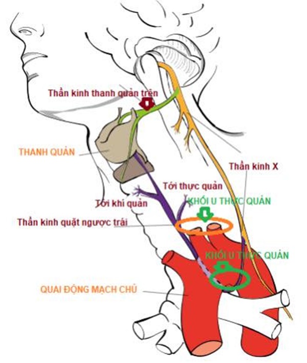Điểm khác biệt trong triệu chứng khàn tiếng, dấu hiệu điển hình của loại ung thư nguy hiểm-2