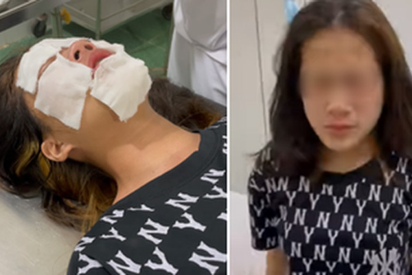 Bé gái 19 tháng tuổi bỏng nặng vì lọ dung dịch hầu hết nhà nào cũng có-3