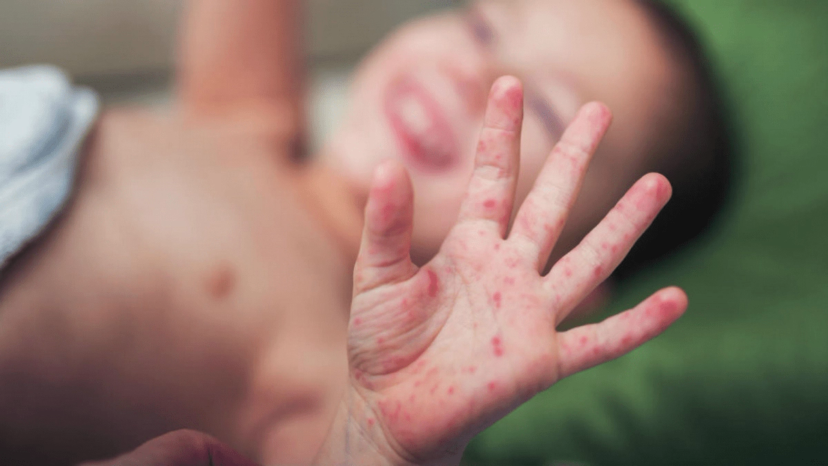 6 trường hợp tử vong vì nhiễm Adenovirus: BS khuyến cáo dấu hiệu nhận biết và việc cần làm để phòng bệnh-2