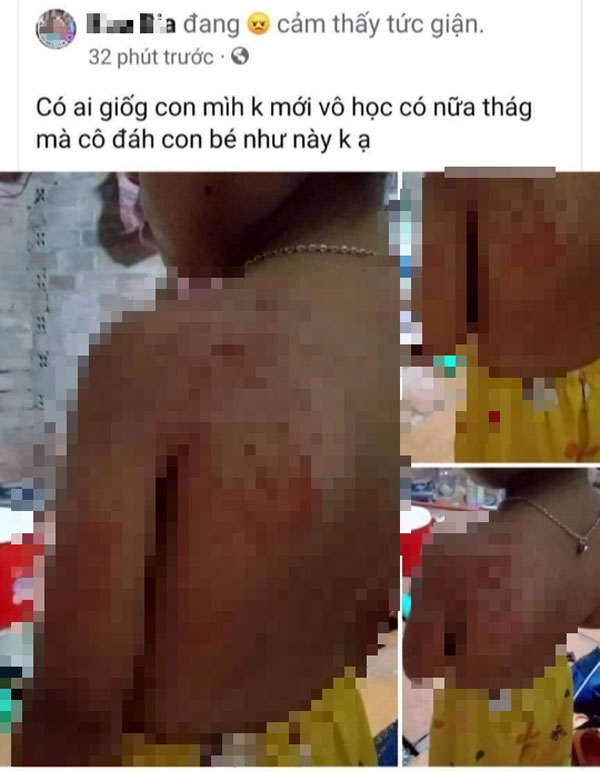 Cô giáo đánh học sinh lớp 1 bầm tím-1